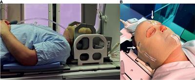 Prospective Clinical Feasibility Study for MRI-Only Brain Radiotherapy